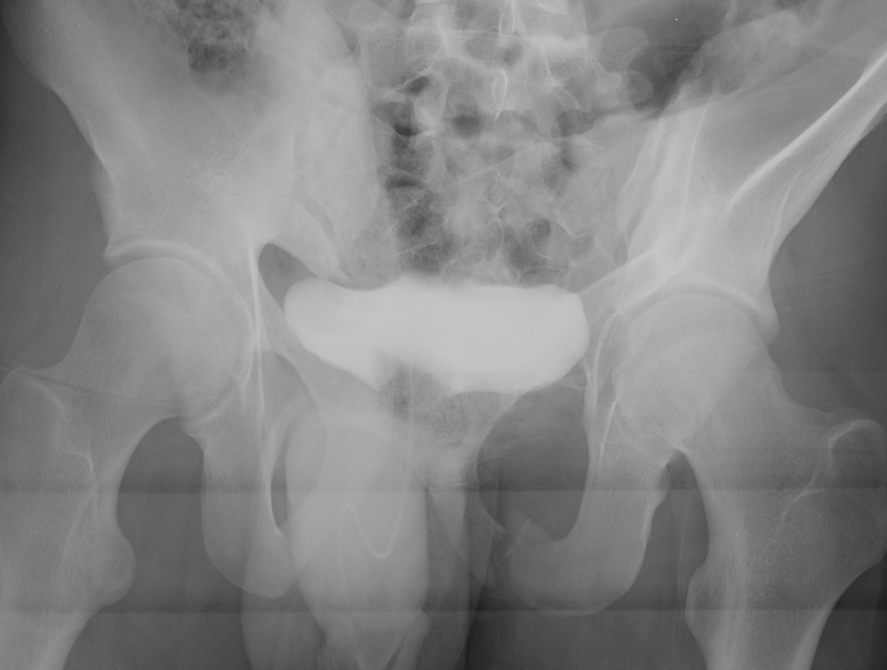 Pelvic Fracture Outlet View